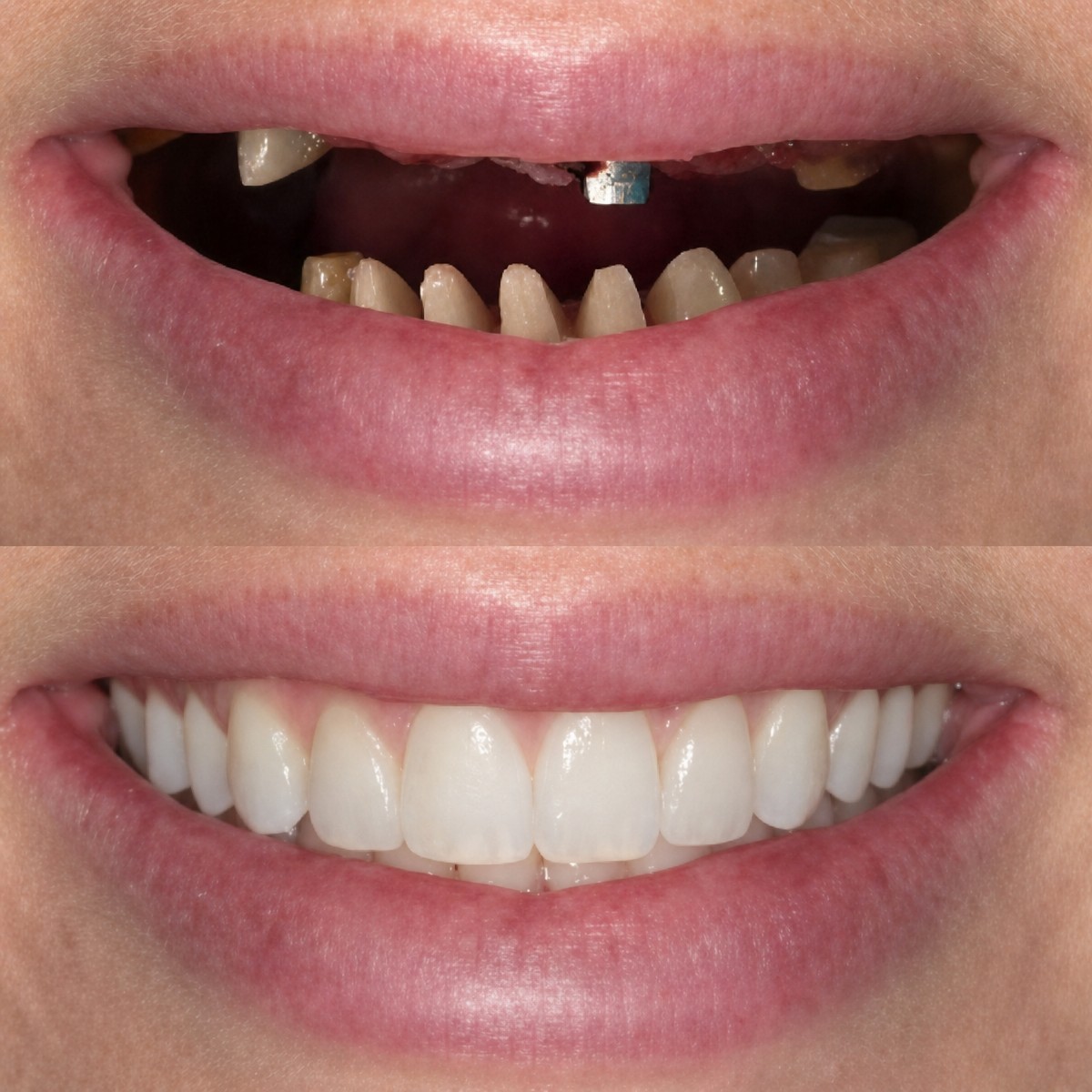 Before and after dental implant results at Excelentis Dental Center – restored natural smile