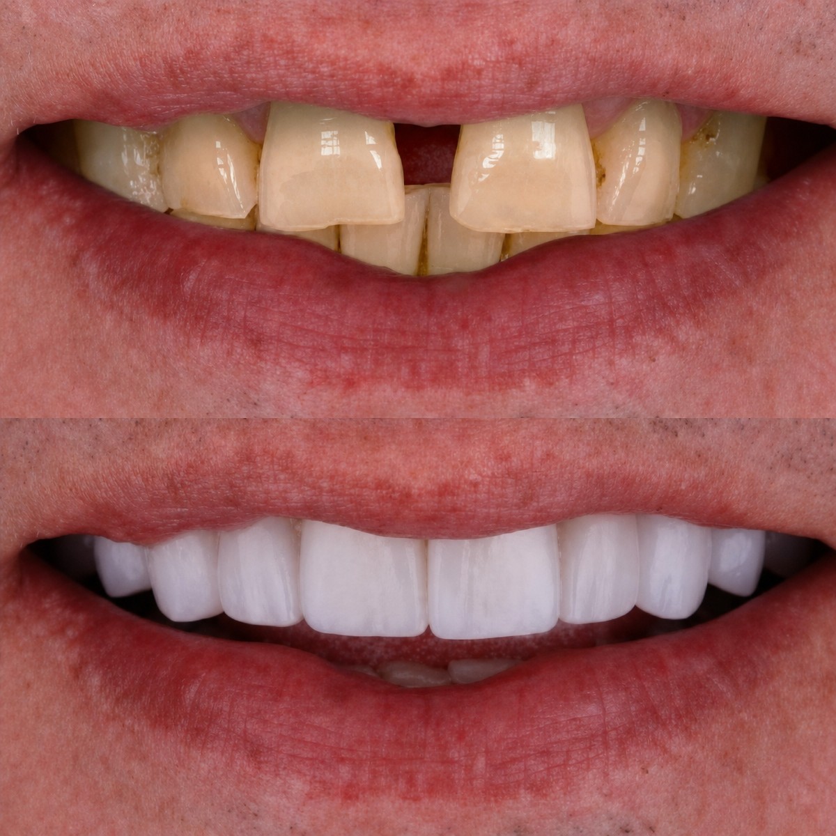 Before and after dental implant results at Excelentis Dental Center, restored natural smile