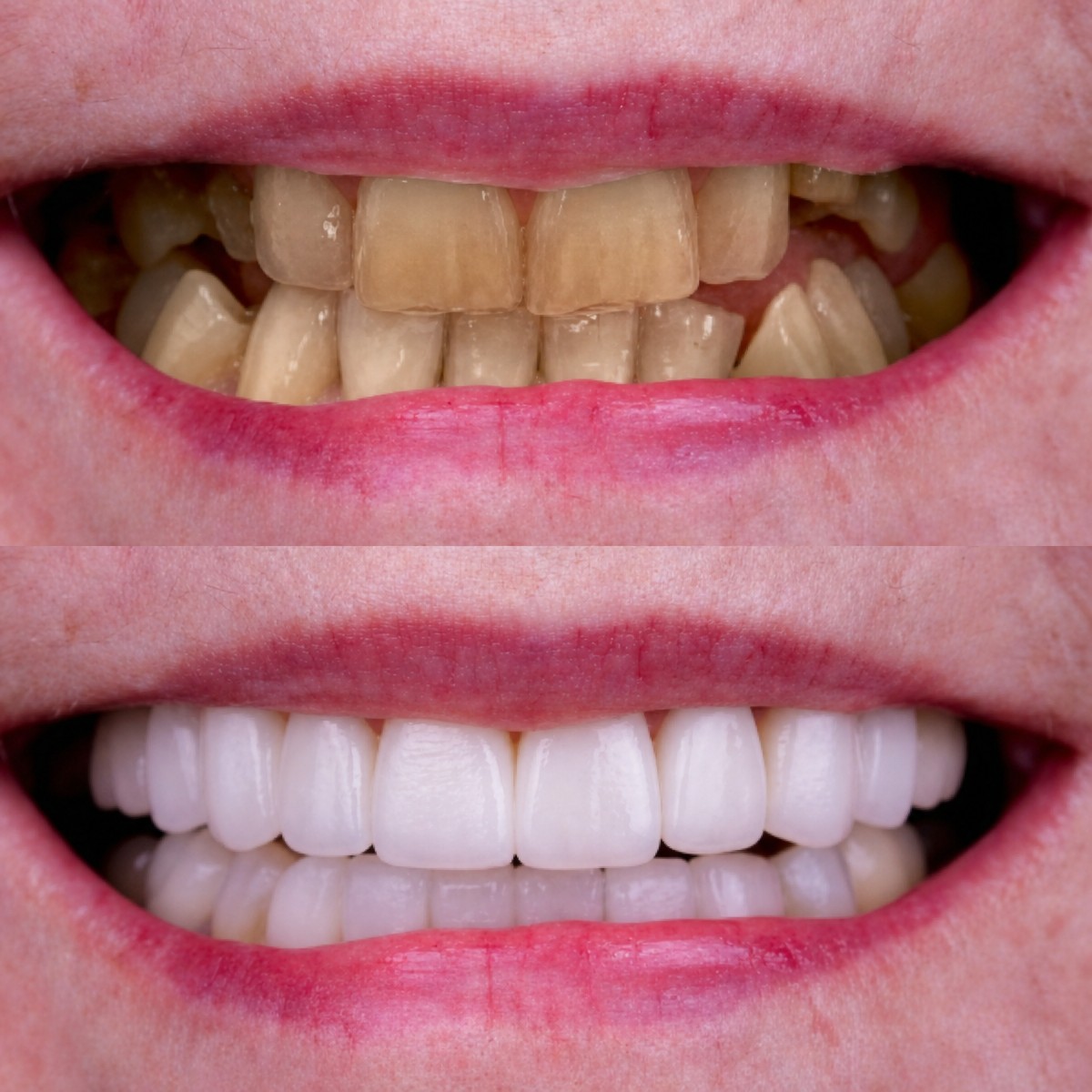 نتائج قبل وبعد زراعة الأسنان في Excelentis Dental Center، تحسين جمالية الابتسامة
