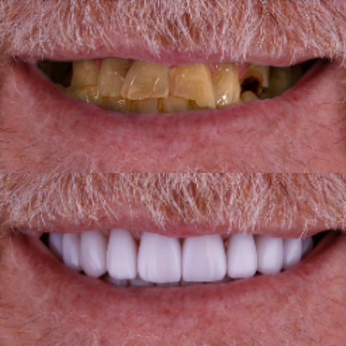 نتائج قبل وبعد زراعة الأسنان في Excelentis Dental Center، ابتسامة طبيعية مستعادة