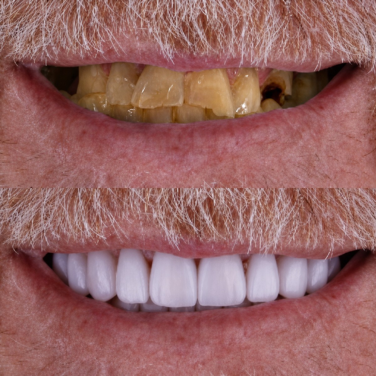 Before and after All-on-4 dental implants result at Excelentis Dental Center, smile restoration