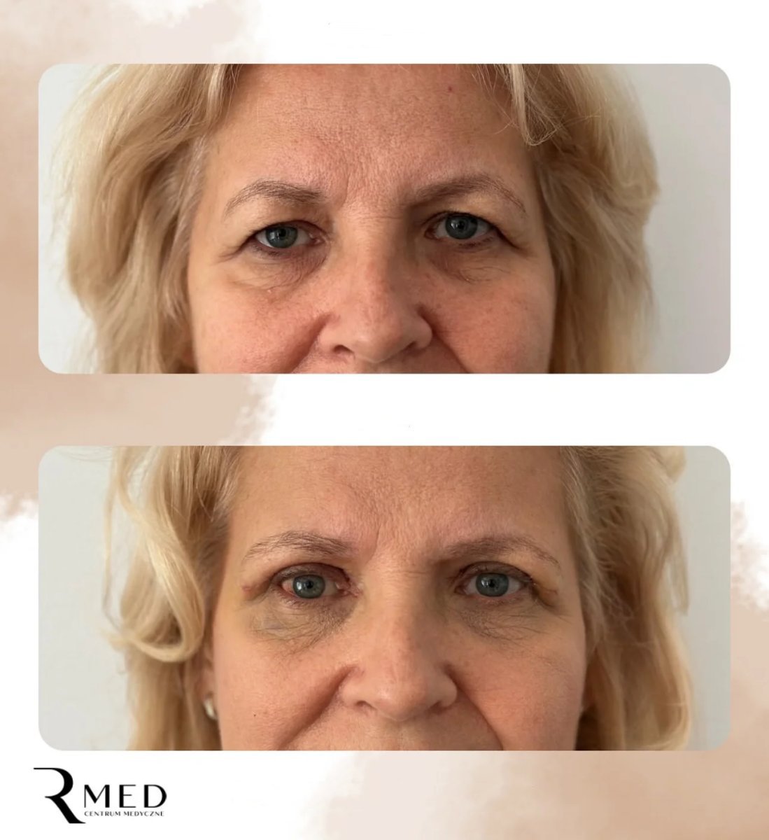 Before and after blepharoplasty results at Rmed Kopernika, upper eyelid correction visible