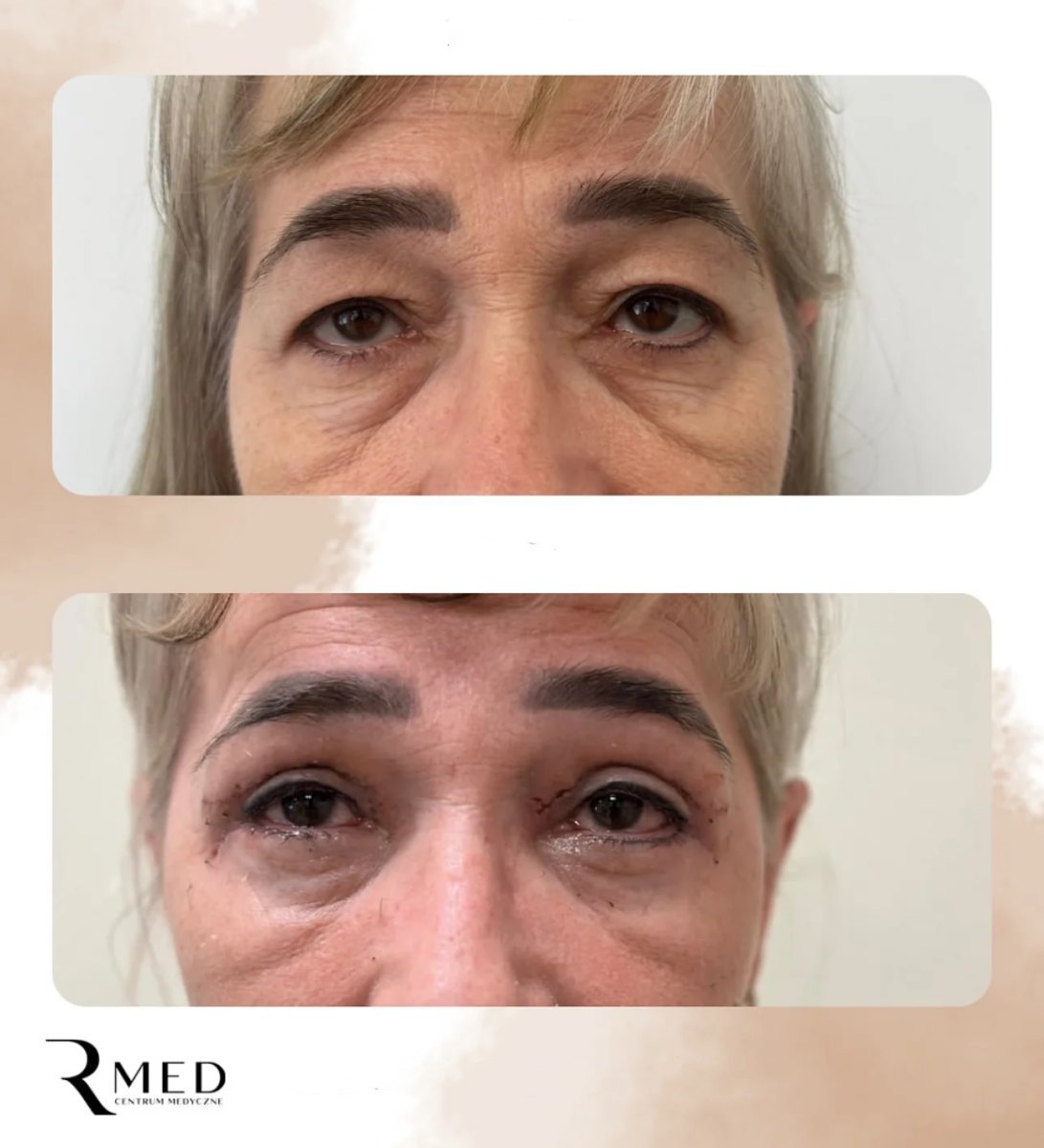 نتائج رأب الجفن قبل وبعد في Rmed Kopernika، تصحيح الجفون لتجديد الشباب