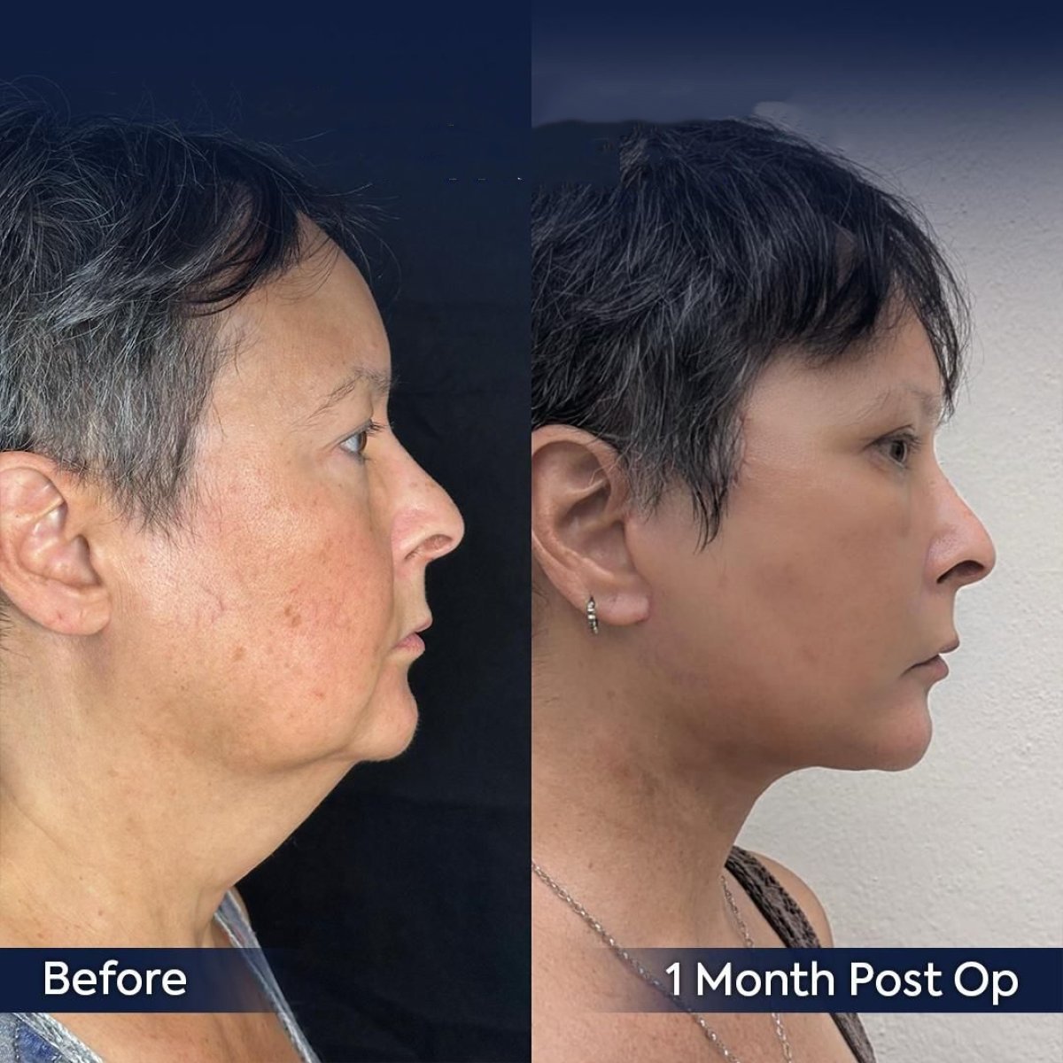 Before and after facial fat transfer at Dr. Safa Manav Clinic, visible contour improvement result
