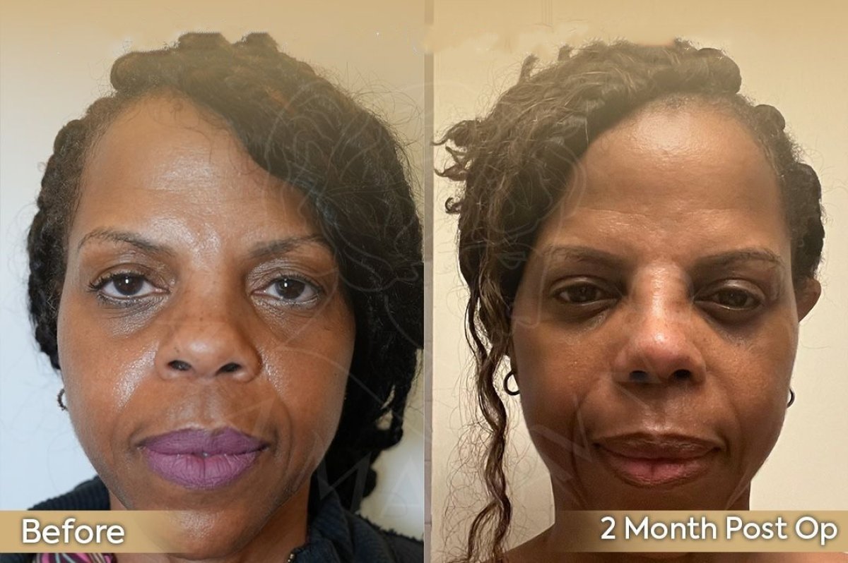Rinoplastia étnica antes y después en Dr. Safa Manav Clinic, resultado a 2 meses