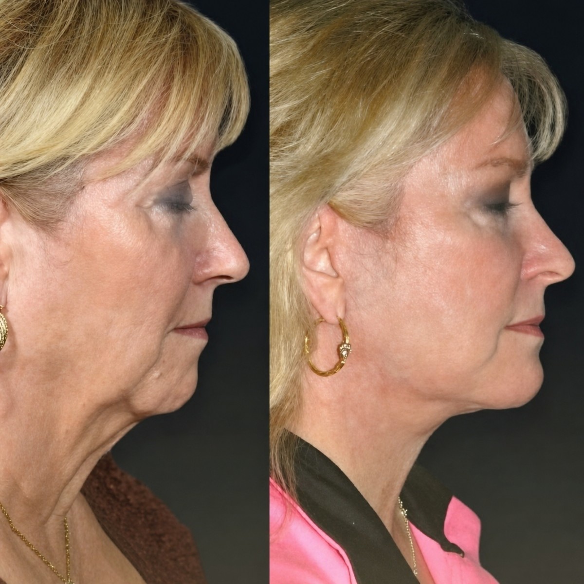 Before and after neck lift results at Memorial Antalya Hospital, visible neck tightening effect