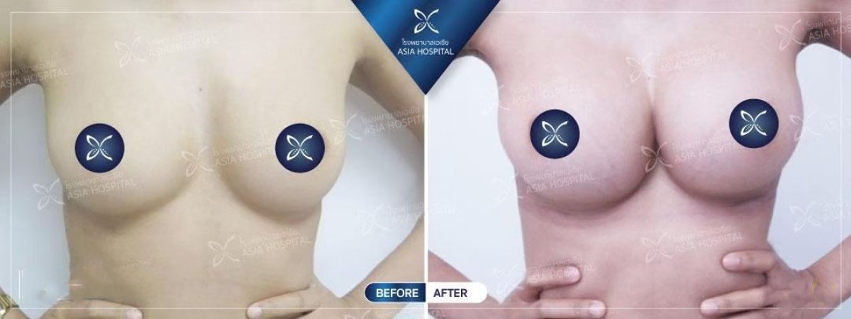 نتائج قبل وبعد تصحيح زراعة الثدي في Asia Cosmetic Hospital، تحسين شكل الثدي