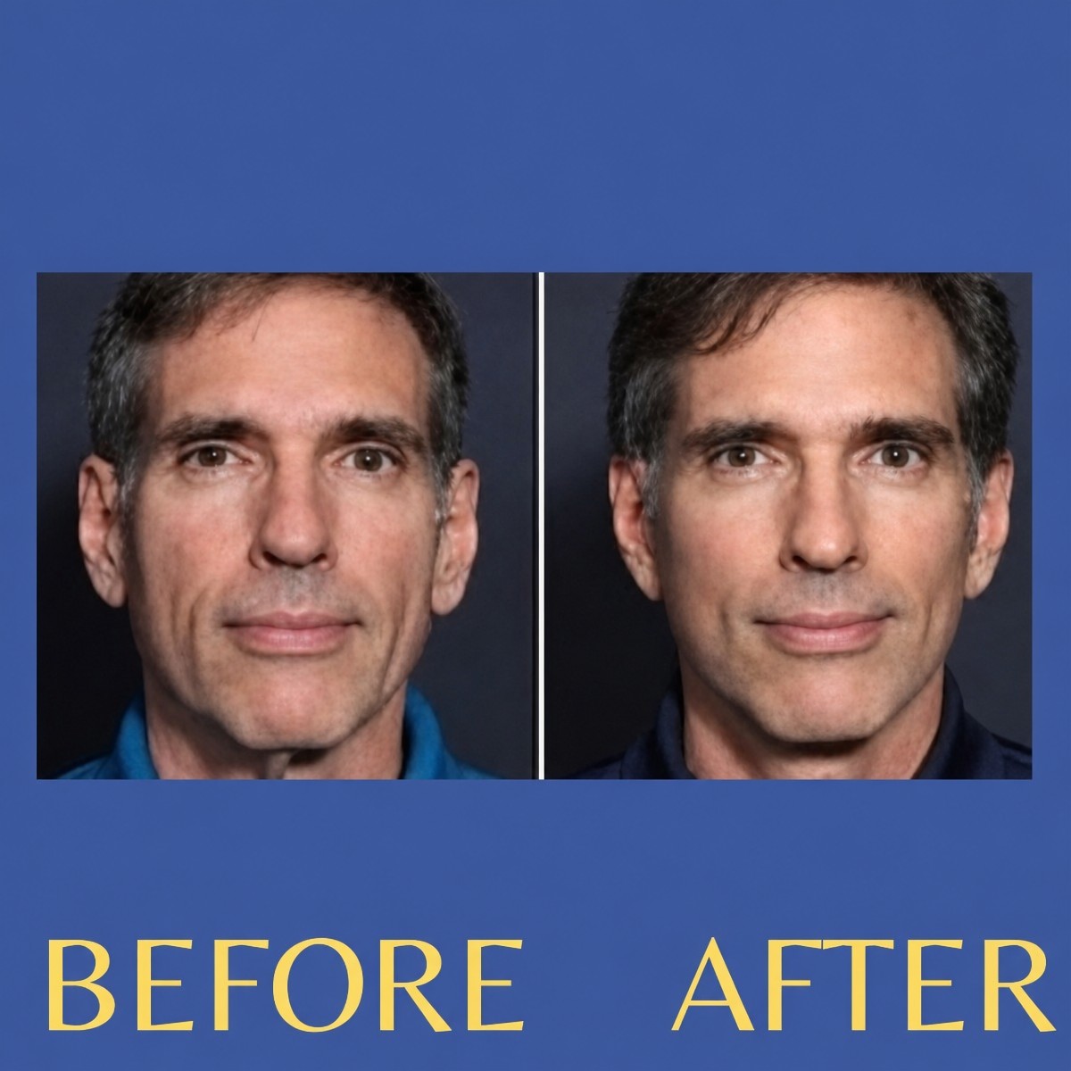 Before and after endoscopic facelift results at ID Clinic Bangkok, facial rejuvenation visible
