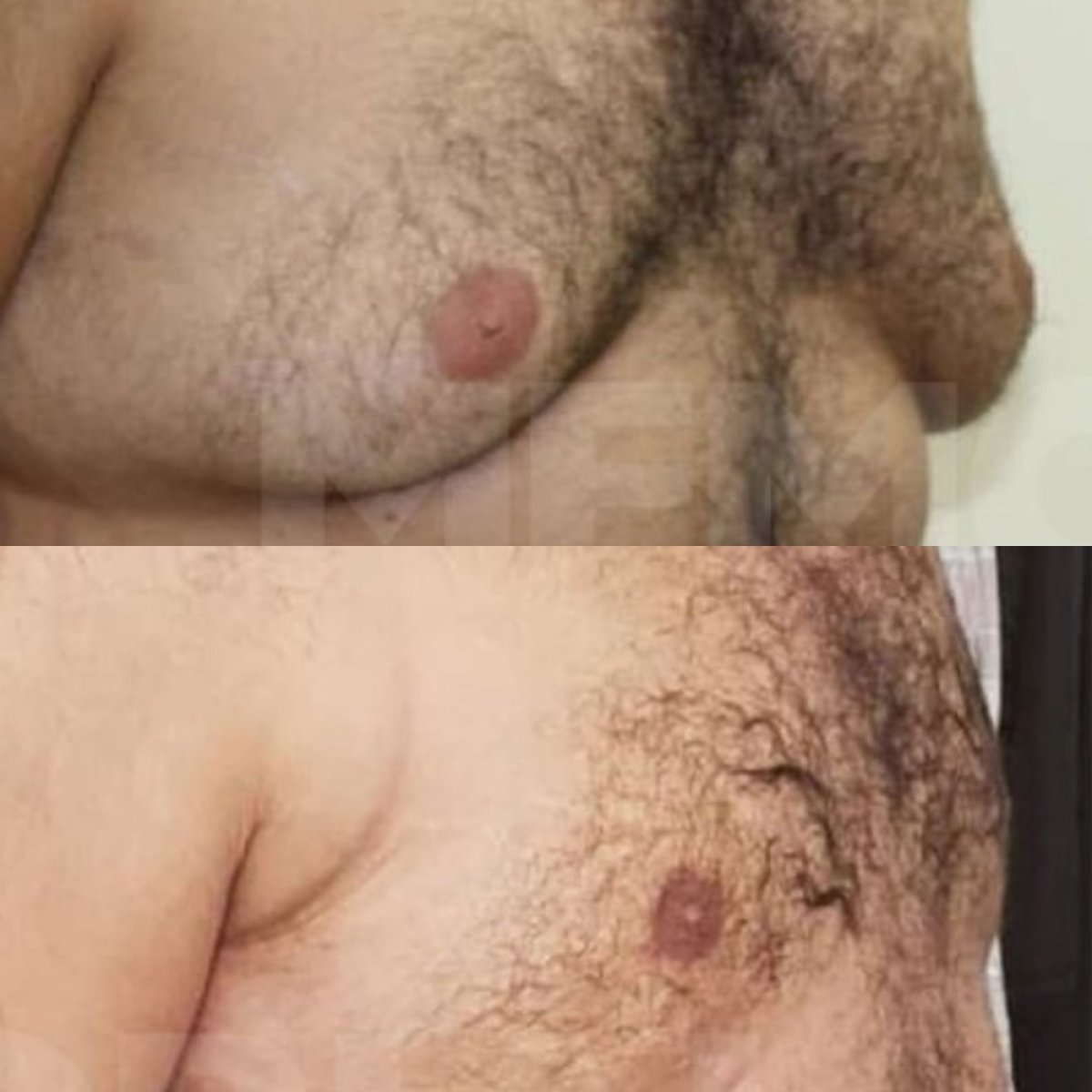 Resultados antes y después de cirugía de ginecomastia en Memorial Göztepe Hospital, contorno de pecho