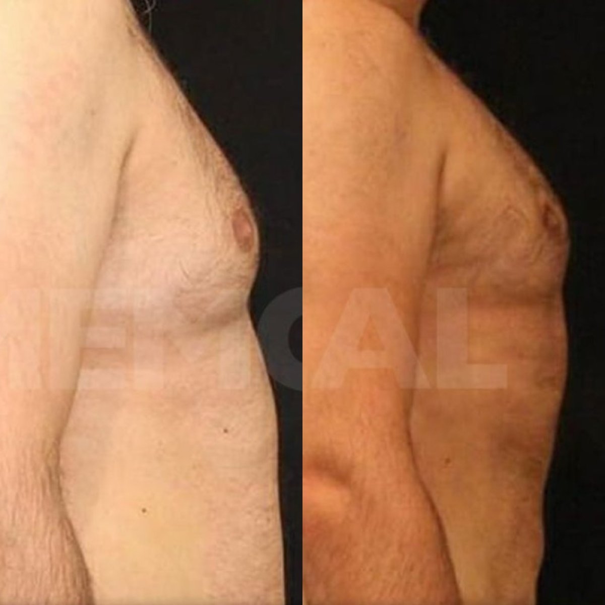 Résultats avant/après chirurgie gynécomastie à Memorial Göztepe Hospital, contour du torse