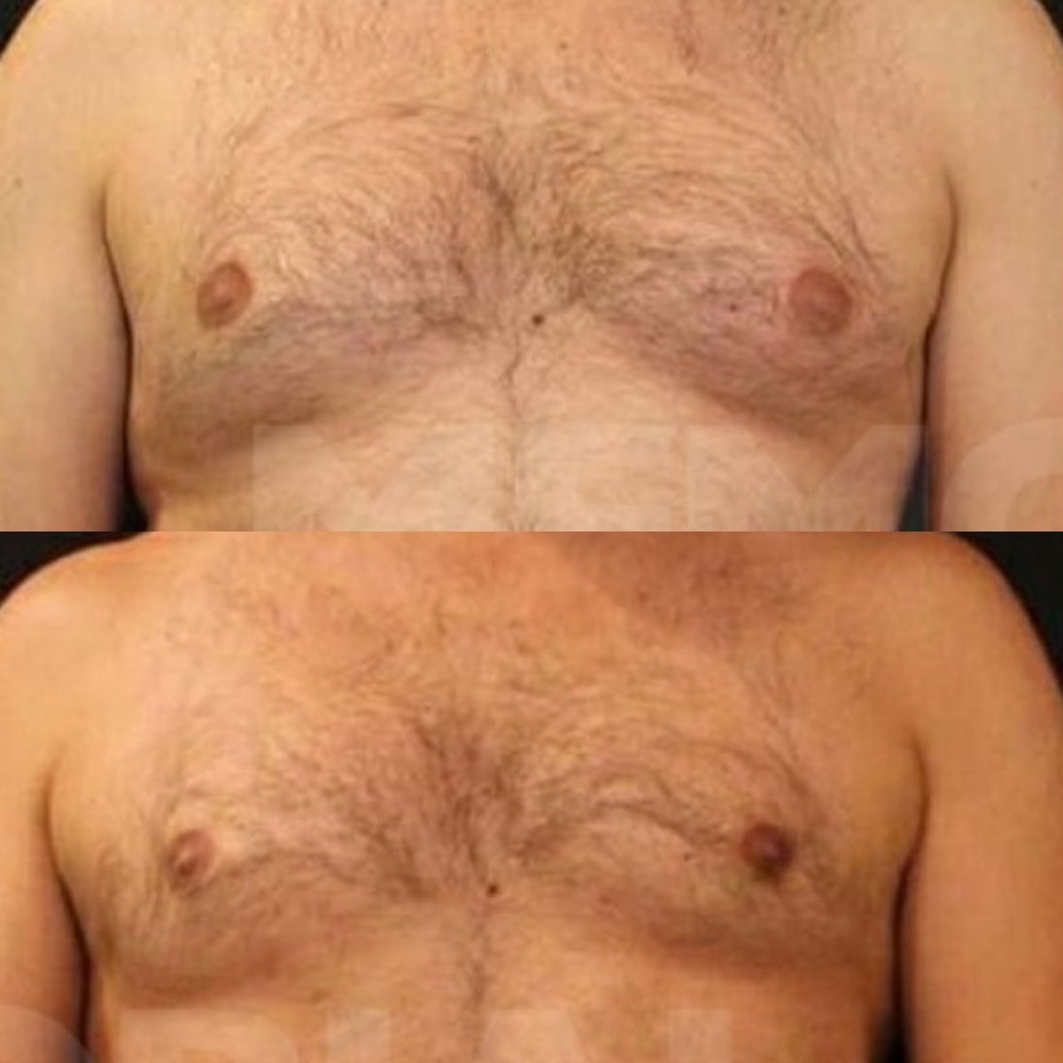 Resultados antes y después de ginecomastia en Memorial Göztepe Hospital, contorno masculino