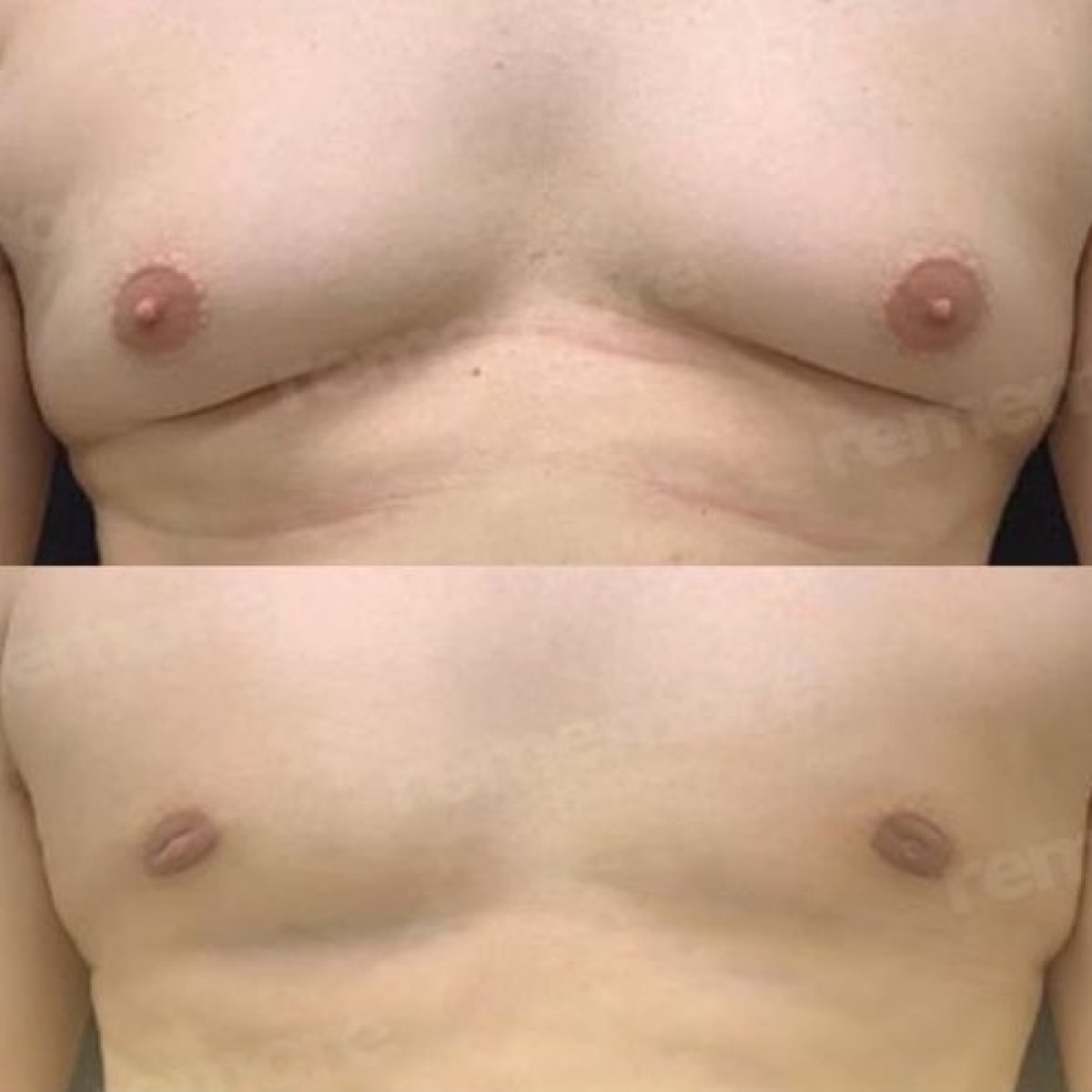 Gynecomastia surgery before and after results at Memorial Göztepe Hospital, flatter chest
