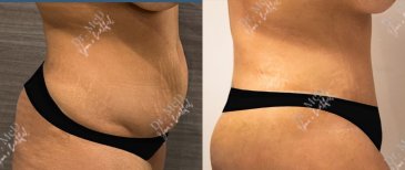 صور قبل وبعد رفع المؤخرة البرازيلية للدكتور Muhammet Mustafa Aydinol