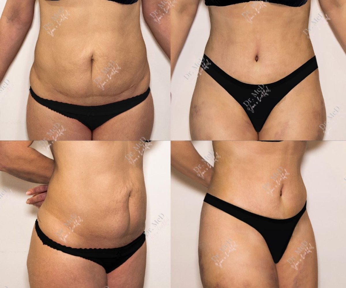 Before and after liposuction results at Dr. MED – visible waist and abdomen contour improvement