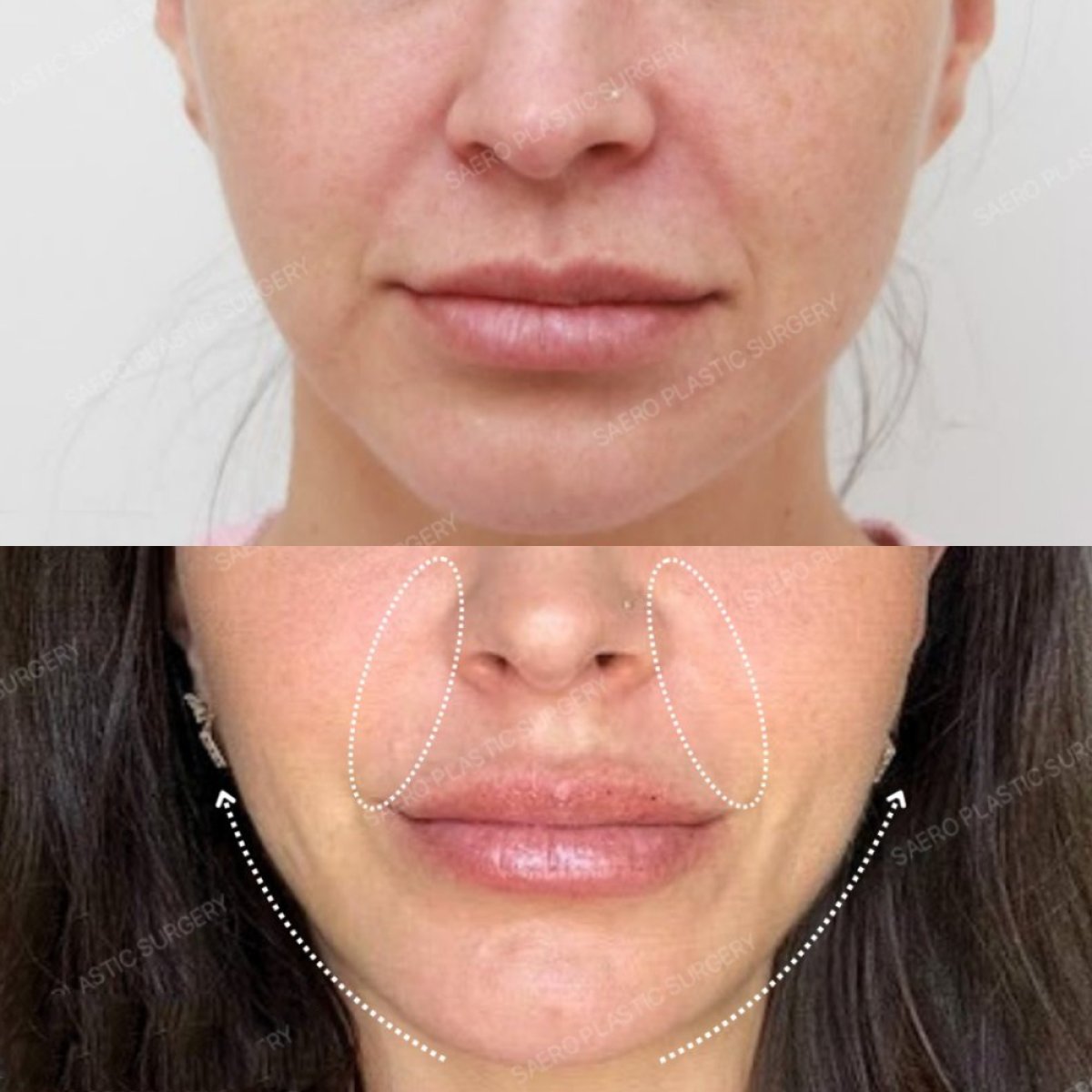 Resultados de minilifting facial antes y después en SAERO Plastic Surgery, rejuvenecimiento facial
