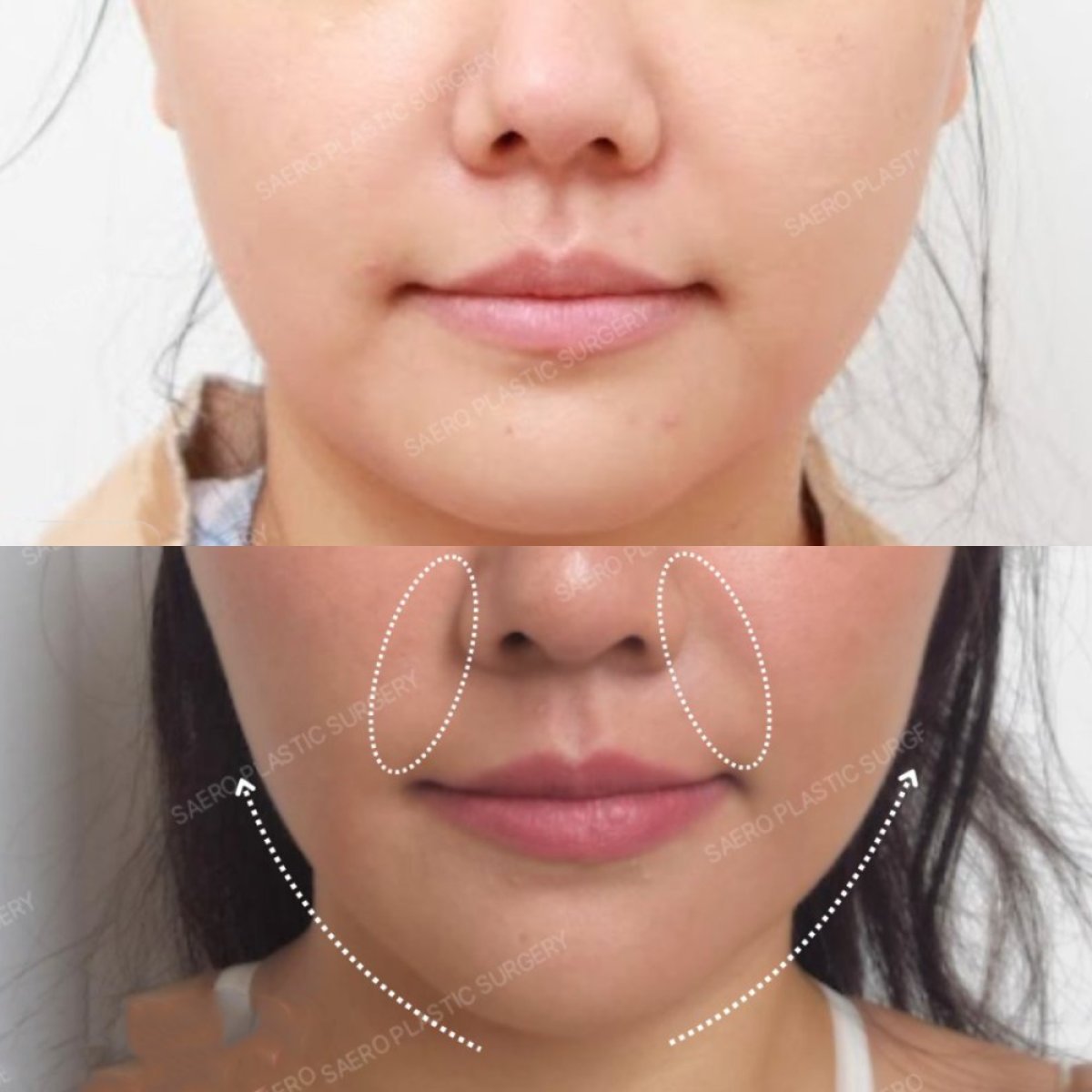 Resultados de minilifting facial antes y después en SAERO Plastic Surgery, mejora del contorno