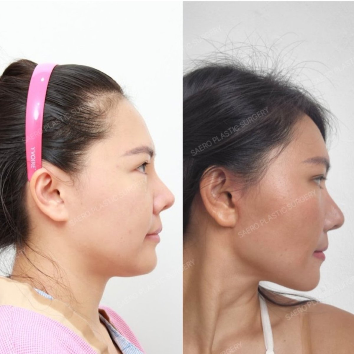 Resultados de minilifting facial antes y después en SAERO Plastic Surgery, mejora del contorno