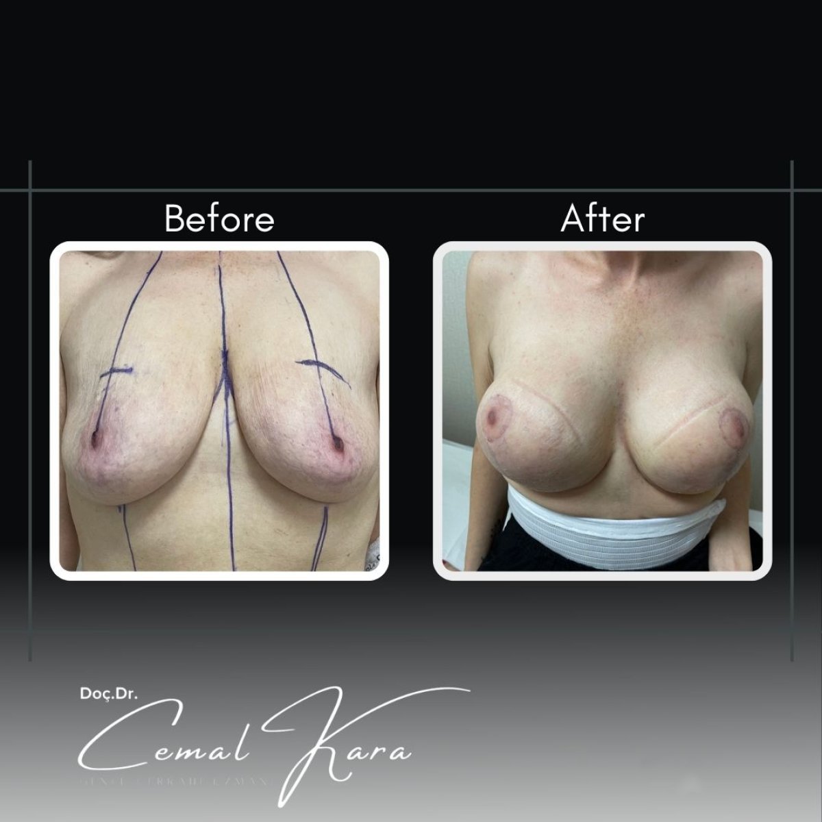 Resultados antes y después de aumento de senos en Assoc.Prof.Dr.Cemal Kara / Medical Park İzmir