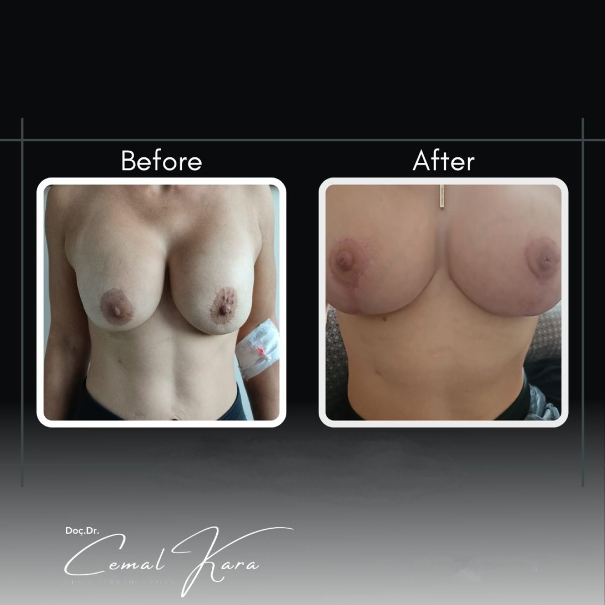 Resultados antes y después de aumento de senos en Assoc.Prof.Dr.Cemal Kara / Medical Park İzmir