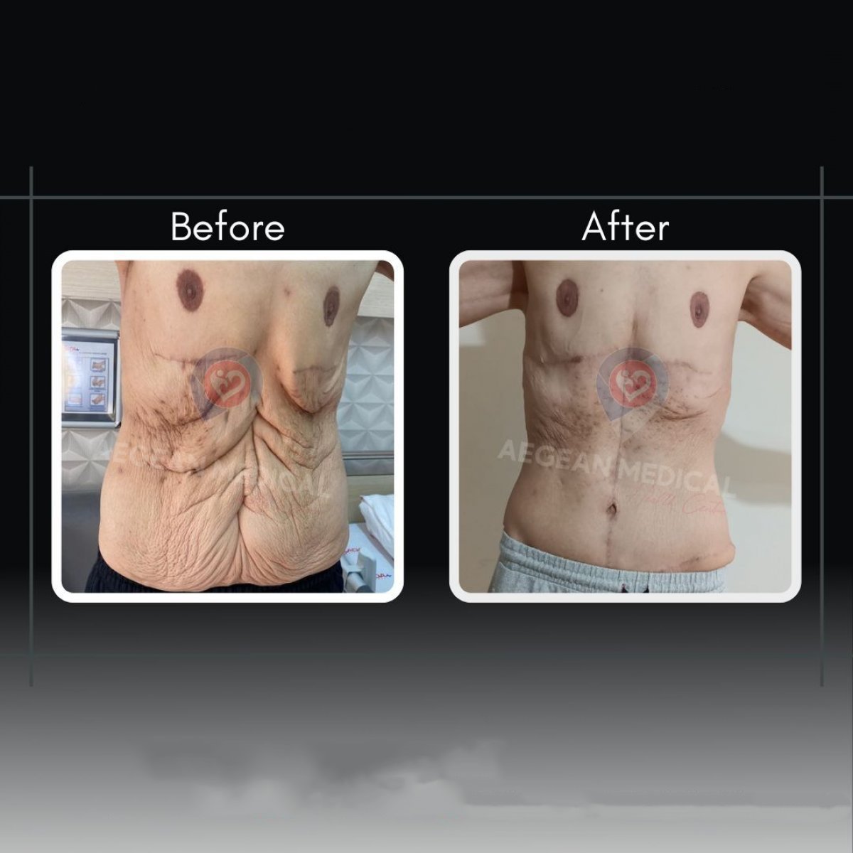 Résultats avant et après abdominoplastie chez Assoc.Prof.Dr.Cemal Kara / Medical Park İzmir Hospital