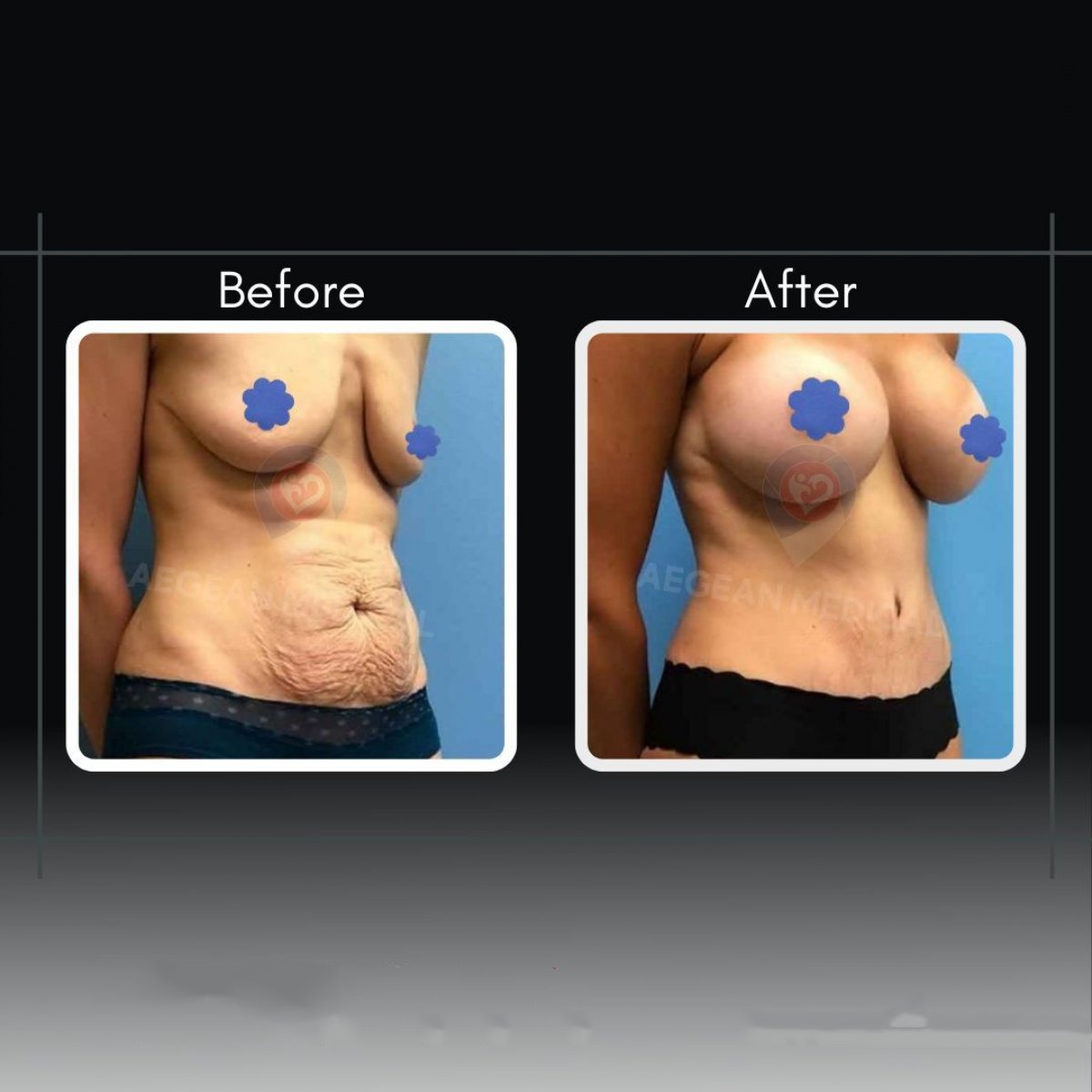 Résultats avant/après abdominoplastie chez Assoc.Prof.Dr.Cemal Kara / Medical Park İzmir Hospital