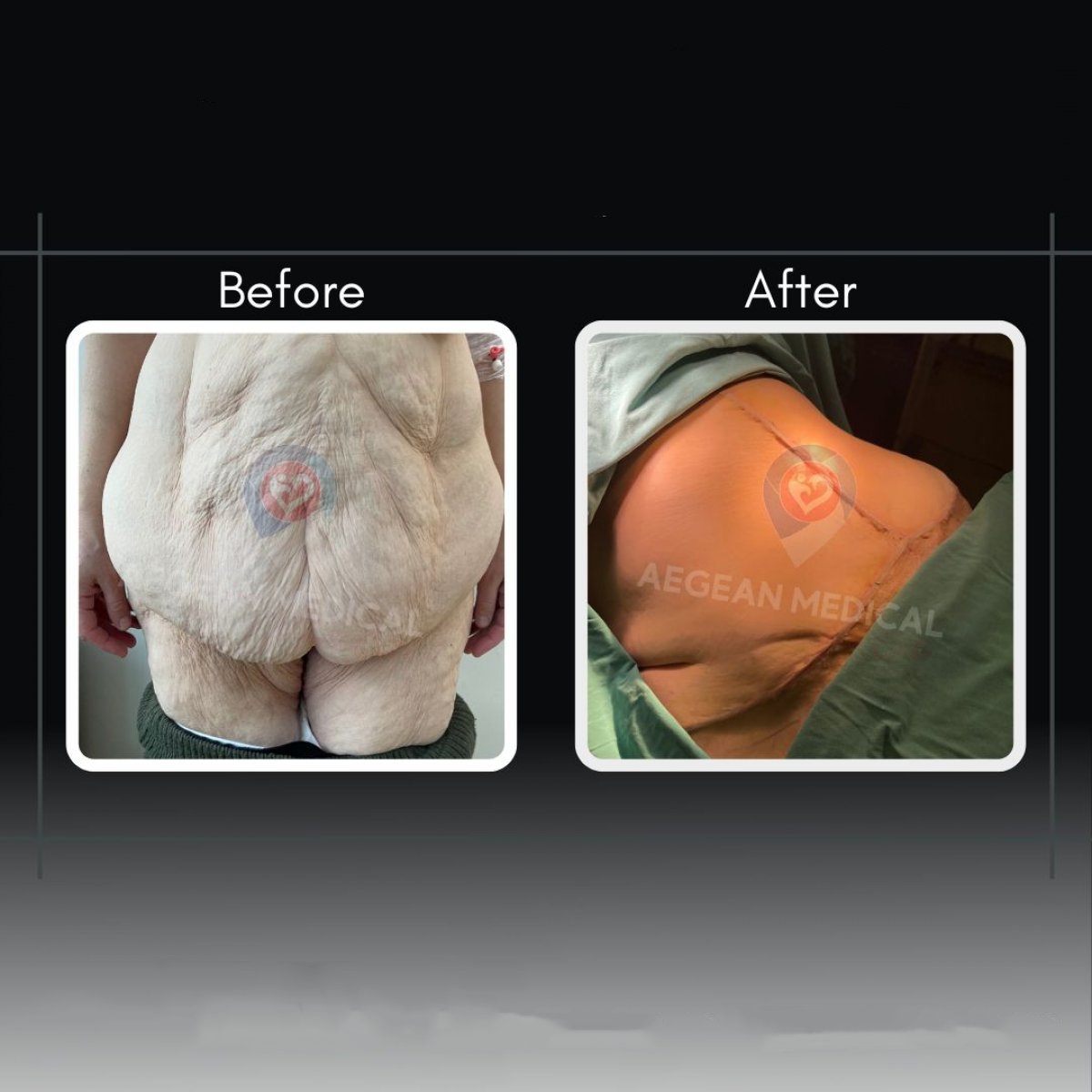 Resultados de abdominoplastia y liposucción antes y después en la clínica Dr. Cemal Kara