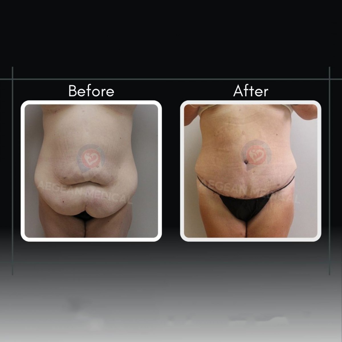 Resultados de abdominoplastia y liposucción antes y después en la clínica Dr. Cemal Kara