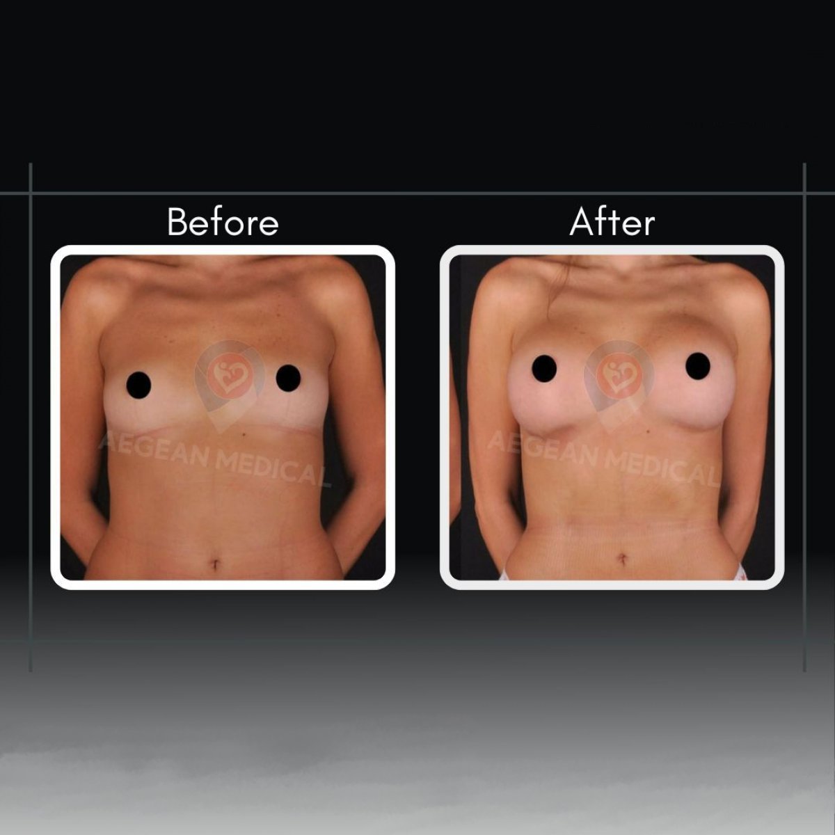Before and after breast augmentation results at Assoc.Prof.Dr.Cemal Kara / Medical Park İzmir