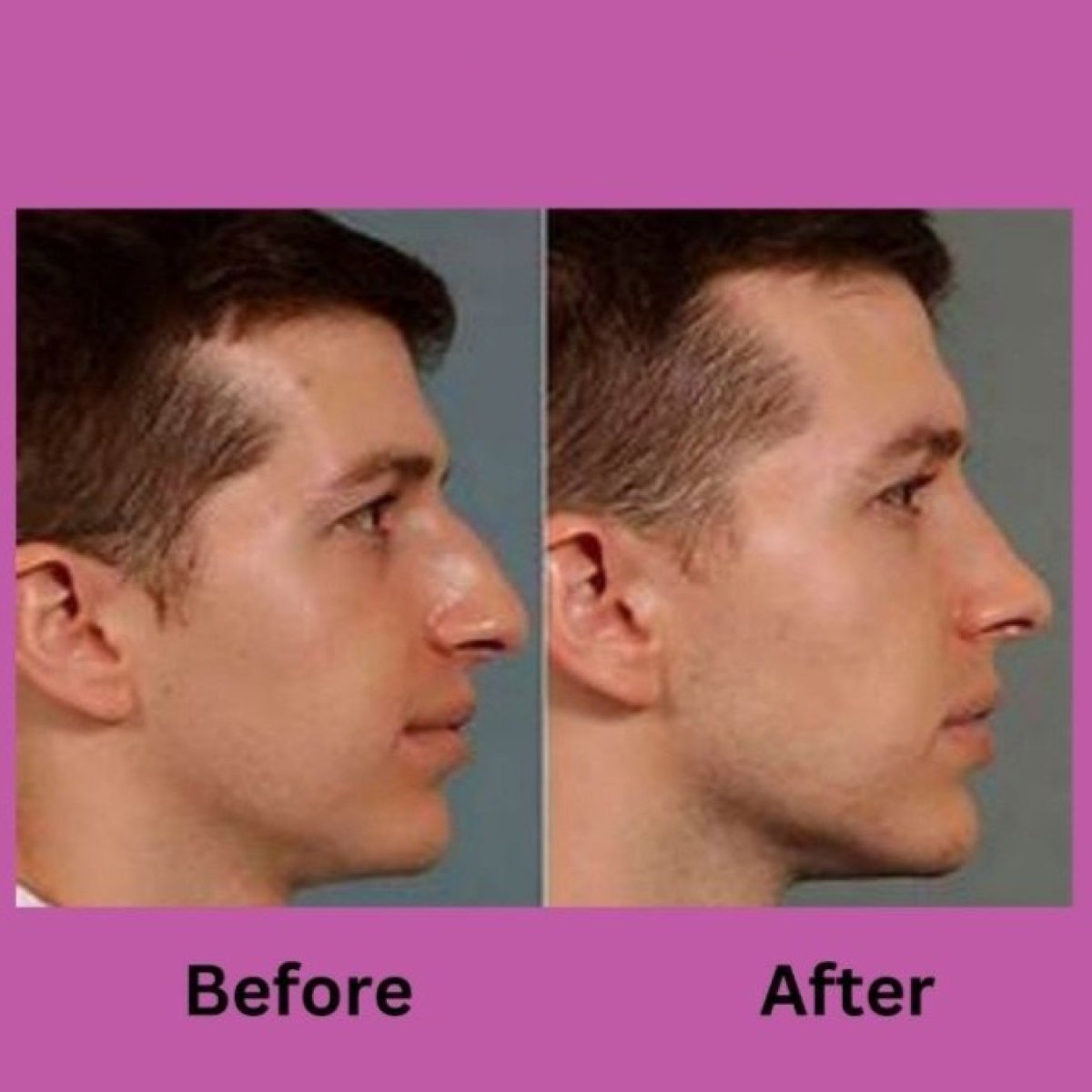 Before and after rhinoplasty results at ID Clinic Bangkok, improved male nose profile