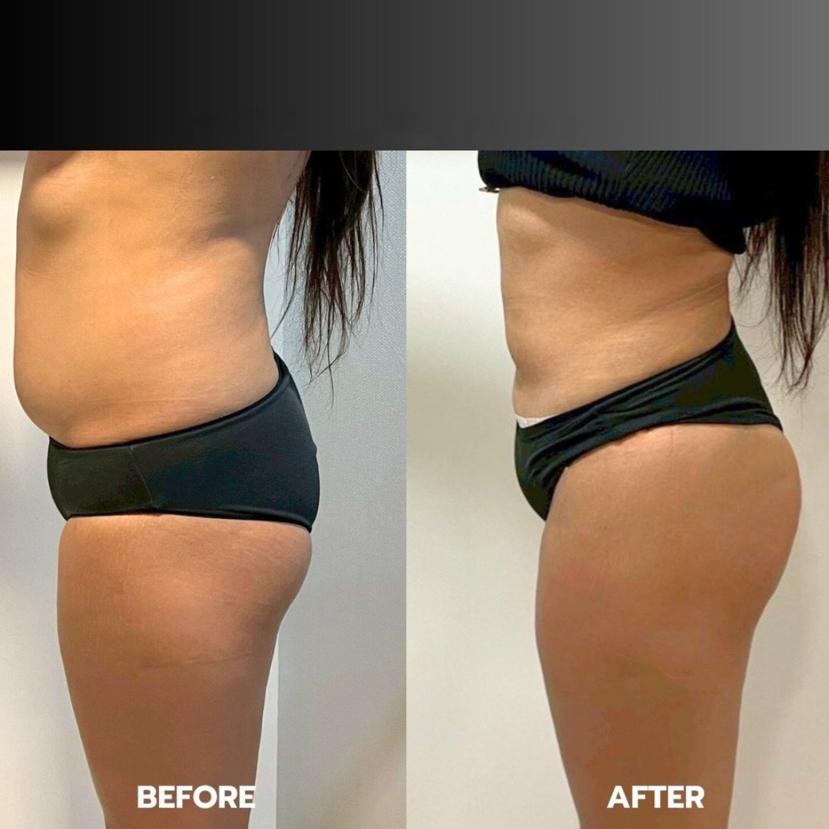 Before and after liposuction results at ID Clinic Bangkok, improved abdominal contour