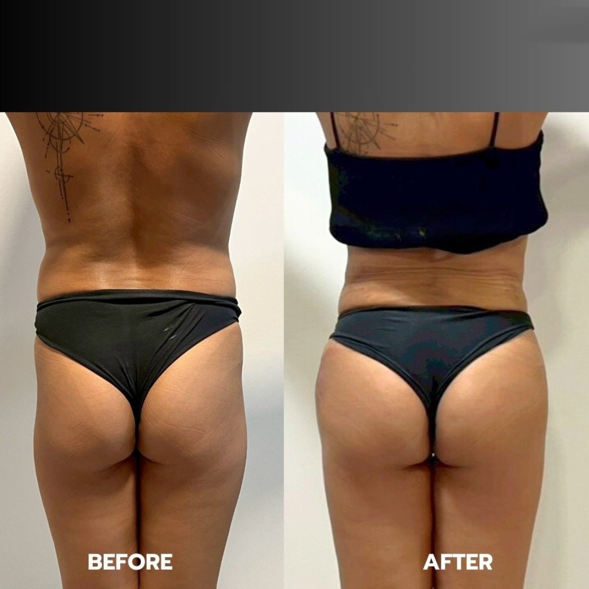 Before and after liposuction results at ID Clinic Bangkok, improved waist and body contour