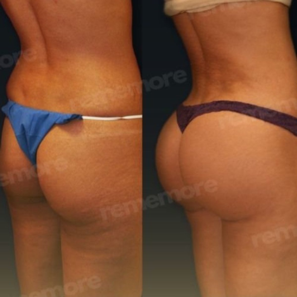 نتائج قبل وبعد عملية Brazilian Butt Lift في مستشفى Memorial Göztepe، تحسين المنحنيات