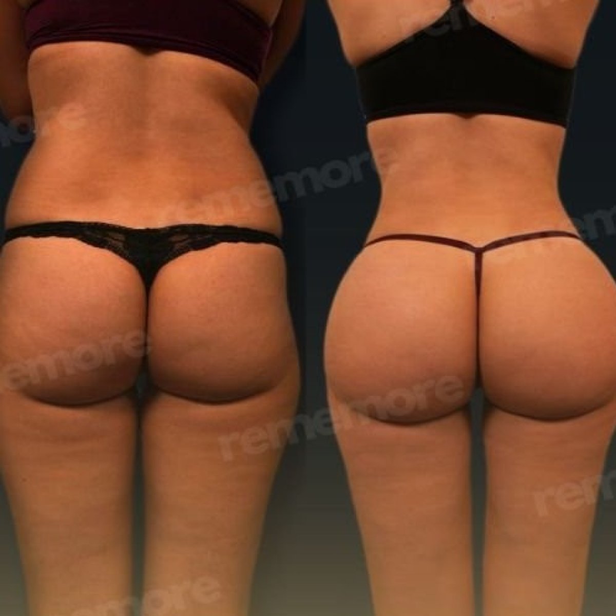 نتائج قبل وبعد عملية Brazilian Butt Lift في مستشفى Memorial Göztepe، تحسين المنحنيات