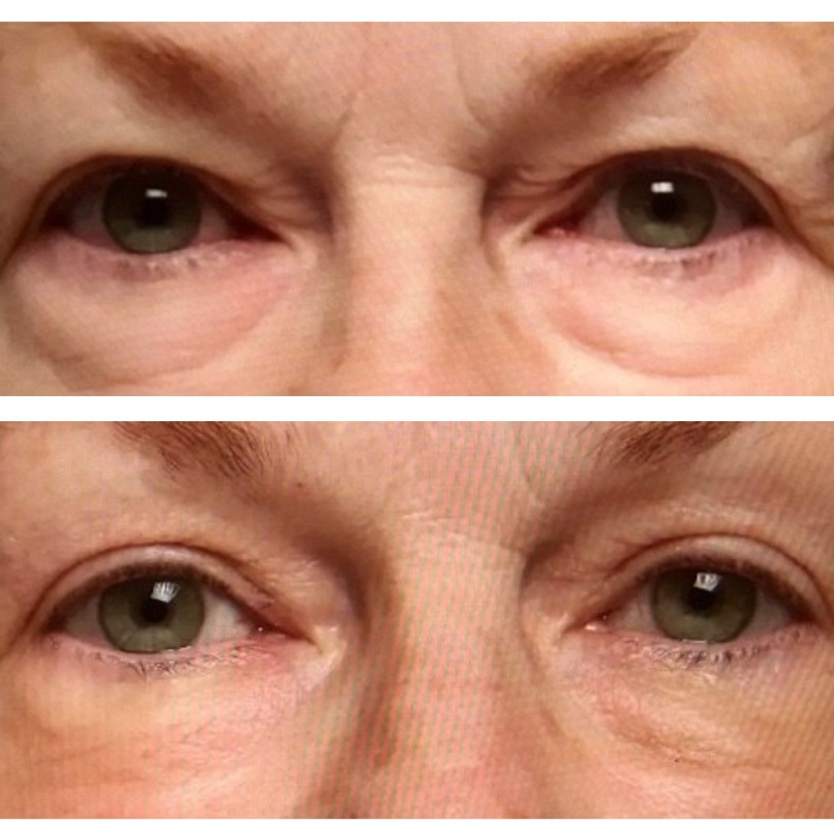 Résultats avant/après Morpheus8 raffermissement du contour des yeux à Clinica Granado Tiagonce