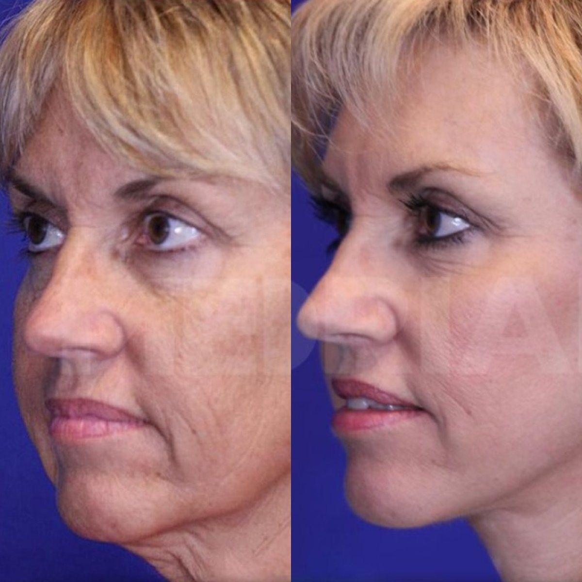 Before and after deep plane facelift results at Memorial Şişli Hospital, facial rejuvenation