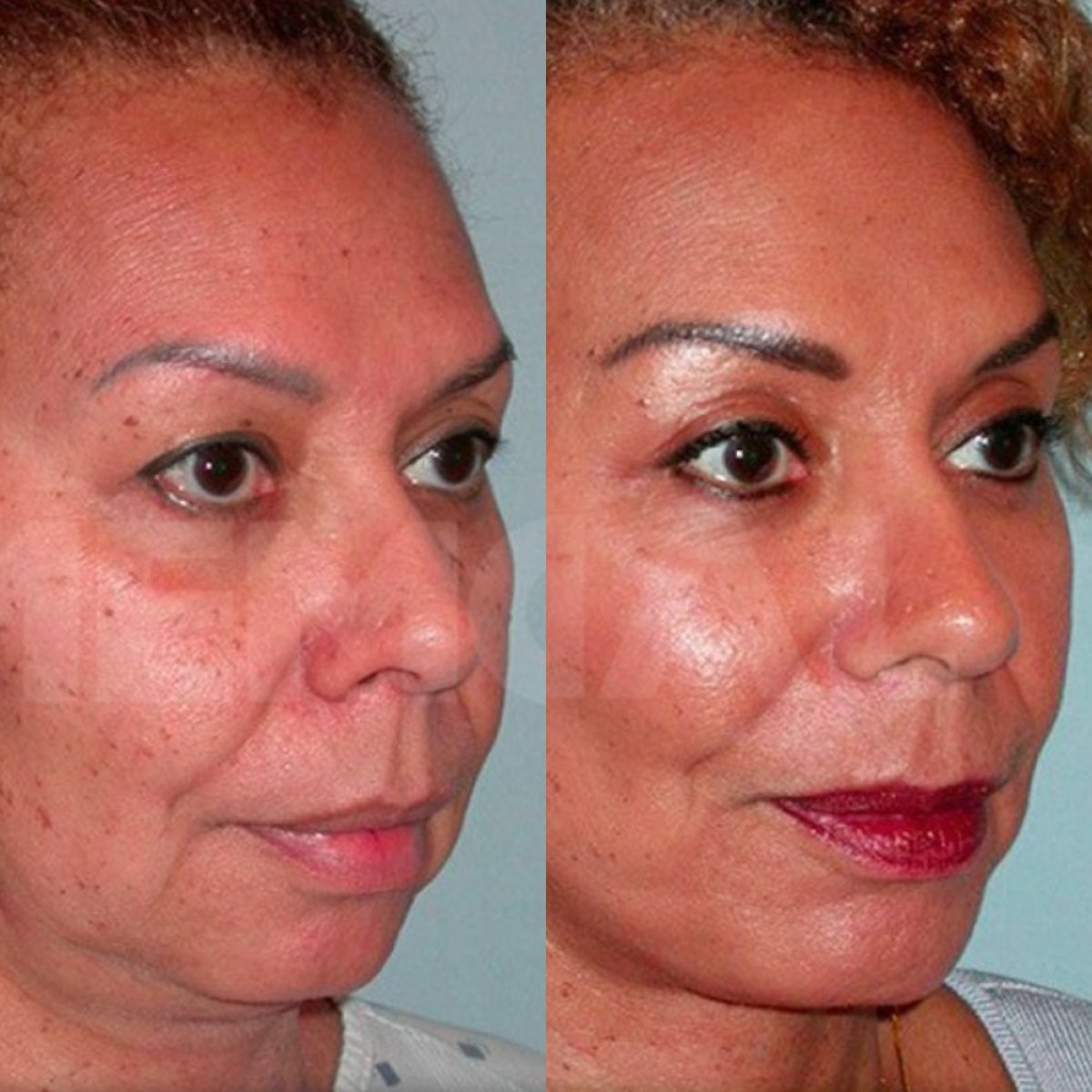 Deep plane facelift before and after results at Memorial Şişli Hospital, facial rejuvenation