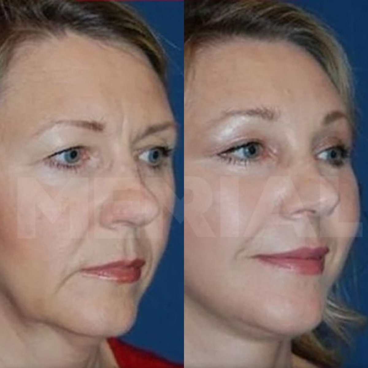 Before and after neck lift results at Memorial Şişli Hospital, visible facial rejuvenation