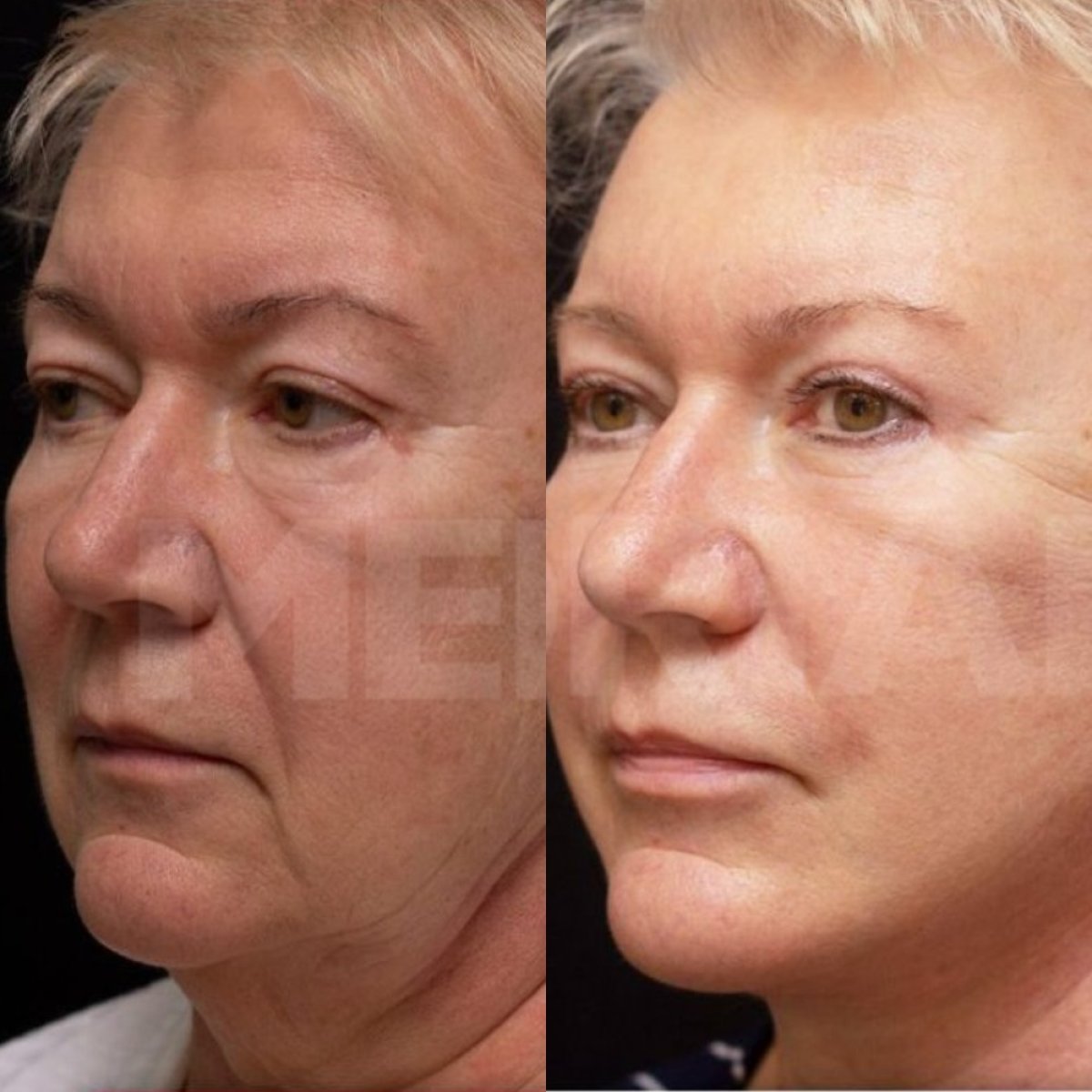 Before and after neck lift results at Memorial Şişli Hospital, visible jawline and neck contour