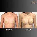 Fotos vor und nach Brustvergrößerung durch Dr. Dr Phatcharasak Kraisornphongsakul Md