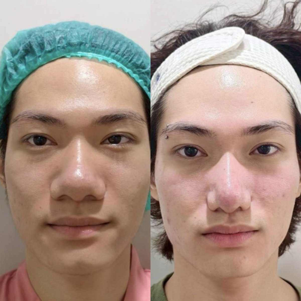 نتائج تجميل الأنف قبل وبعد في Charismma Clinic، إعادة تشكيل الأنف بمظهر طبيعي