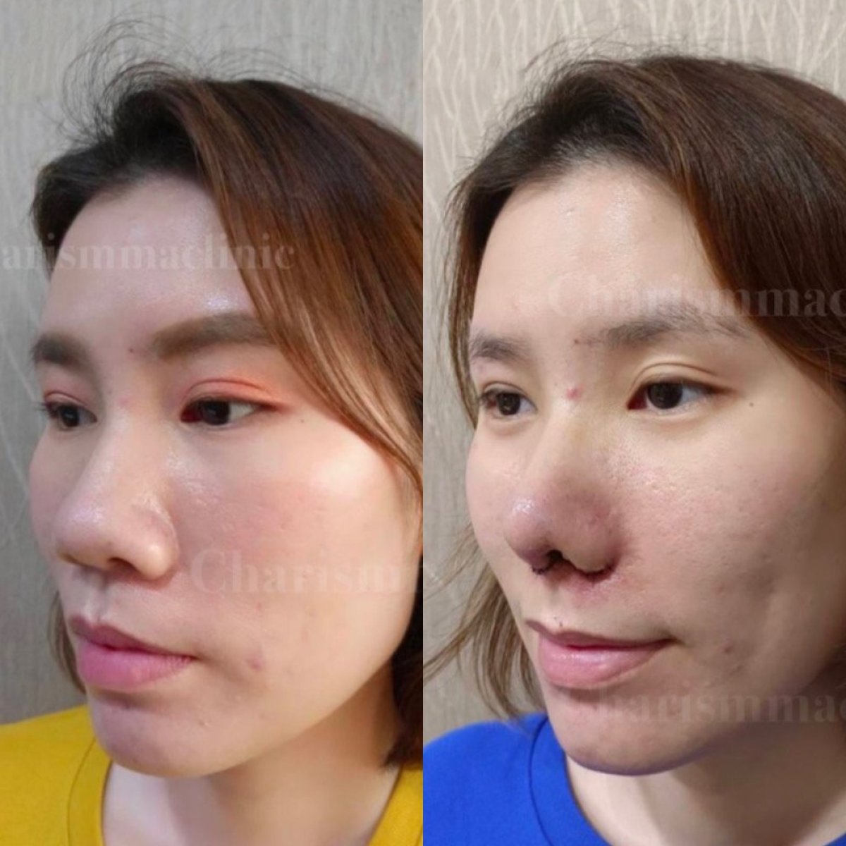 نتائج تجميل الأنف قبل وبعد في Charismma Clinic، تغيير واضح لشكل الأنف
