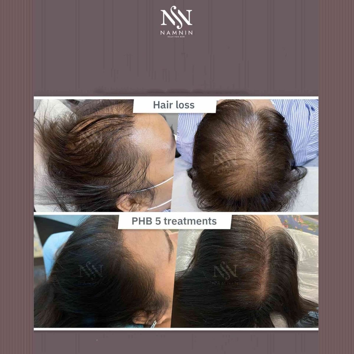 قبل وبعد علاج ميزوثيرابي الشعر في Namninforv Clinic – نتائج نمو الشعر واضحة