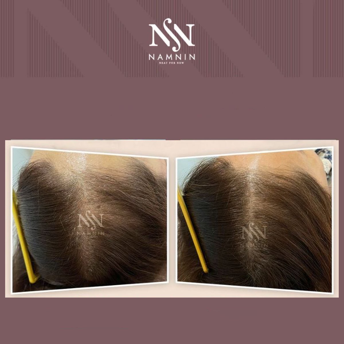 قبل وبعد علاج ميزوثيرابي الشعر في عيادة Namninforv، تحسن كثافة الشعر