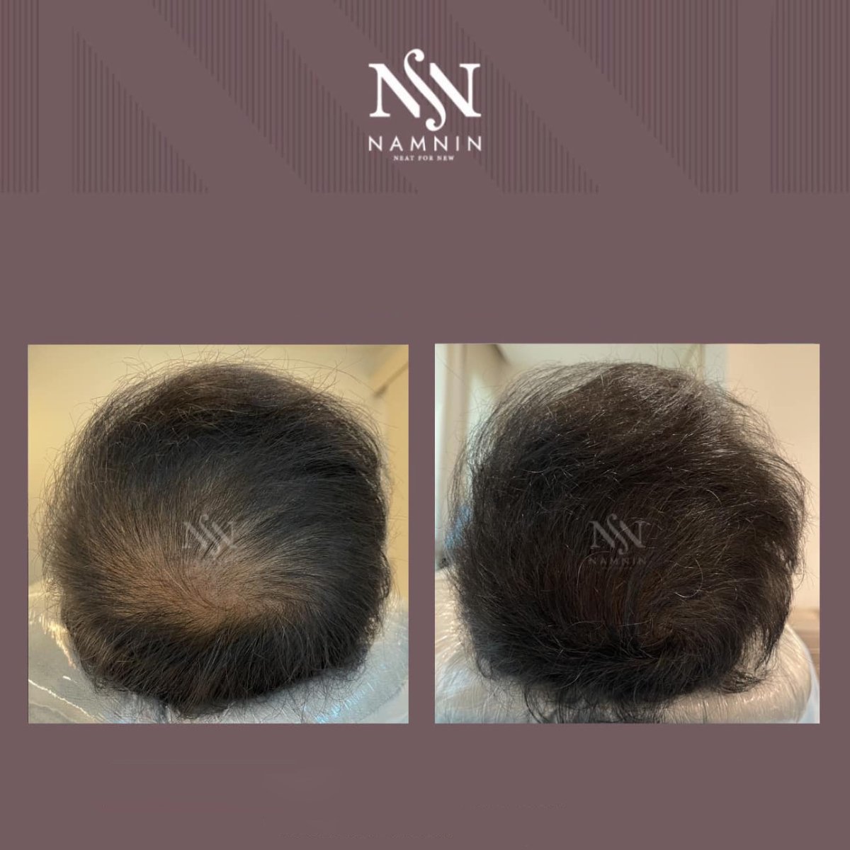 Before and after hair mesotherapy results at Namninforv Clinic – improved hair density