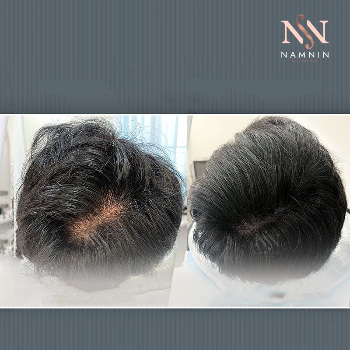 Before and after hair mesotherapy results at Namninforv Clinic, improved hair density
