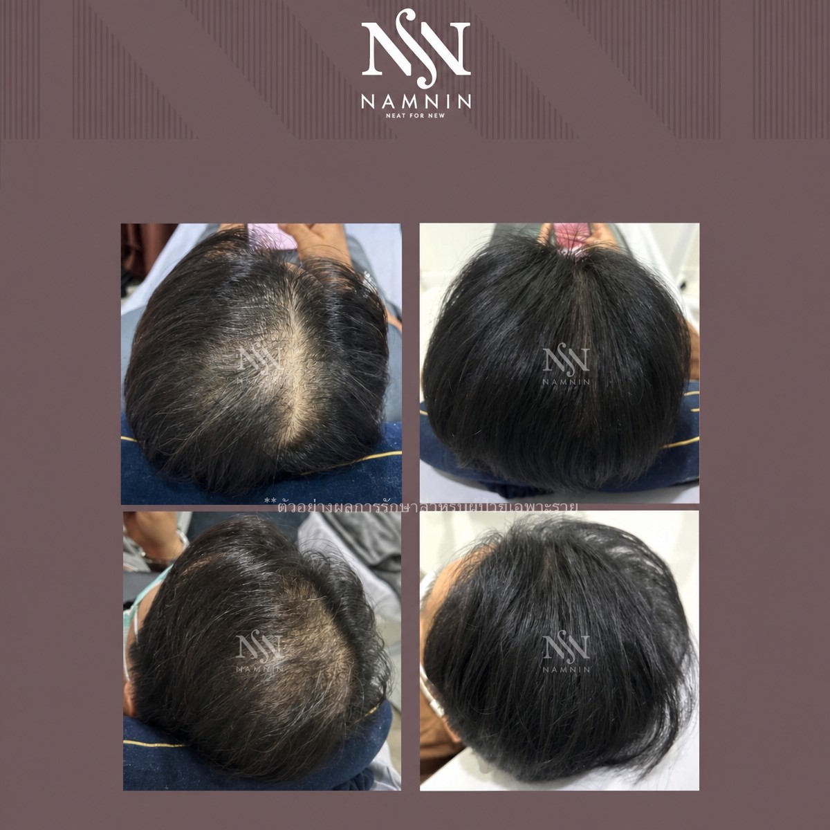 Before and after hair mesotherapy results at Namninforv Clinic – improved hair density