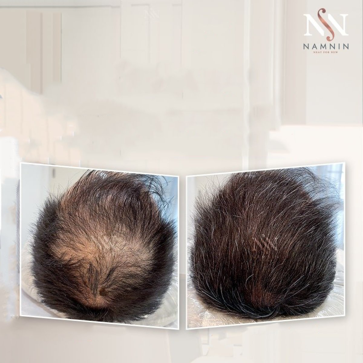 نتائج ميزوثيرابي الشعر قبل وبعد في عيادة Namninforv – كثافة شعر محسنة
