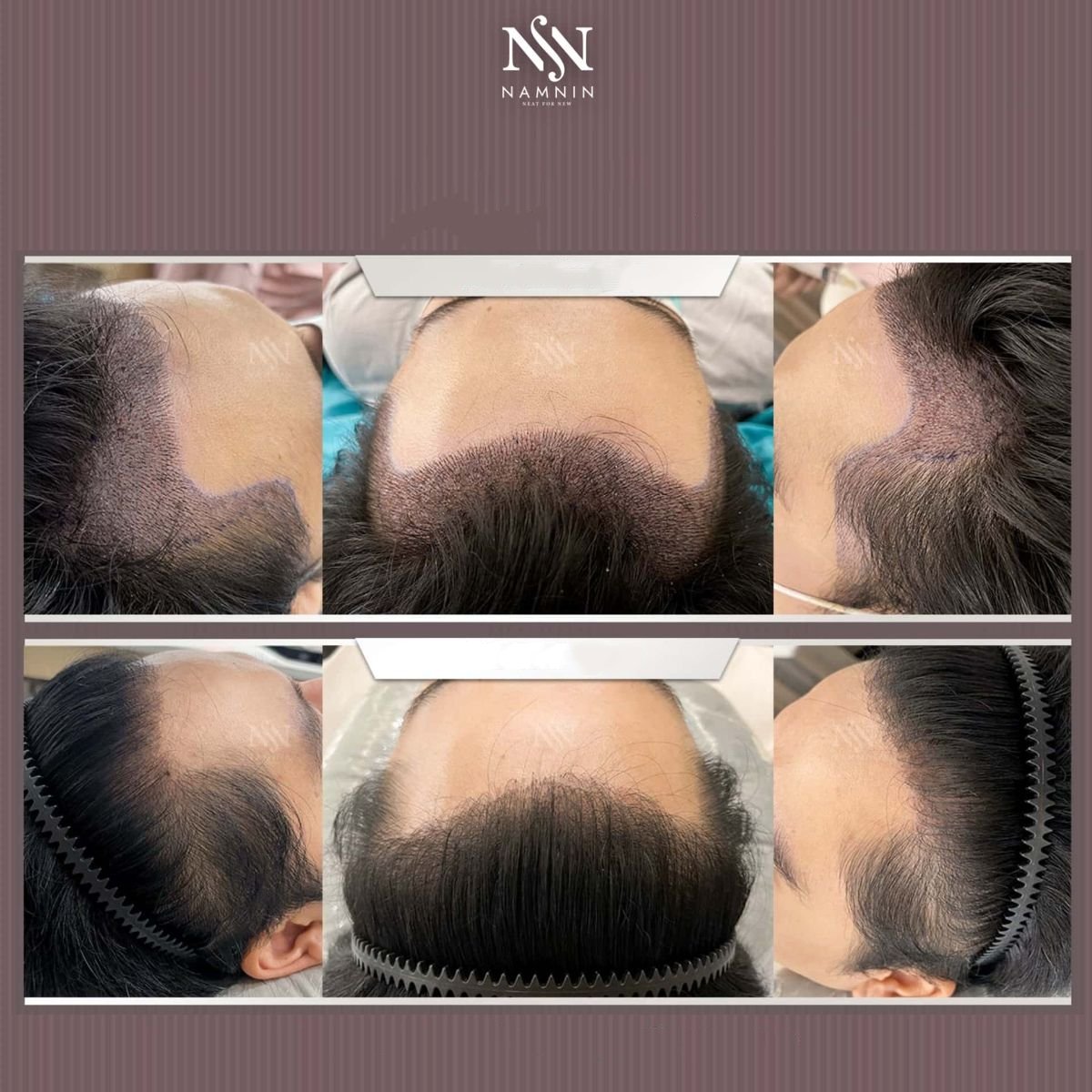 Before and after hair transplant results at Namninforv Clinic, restored fuller hairline