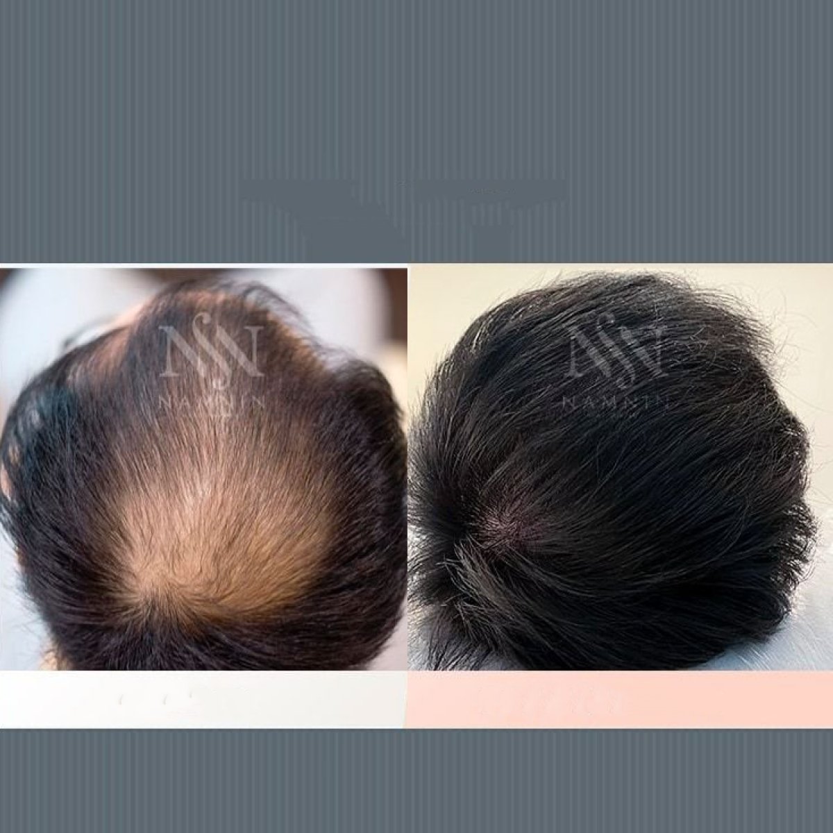 Vorher-nachher-Ergebnis Haartransplantation bei Namninforv Clinic – dichteres Haar
