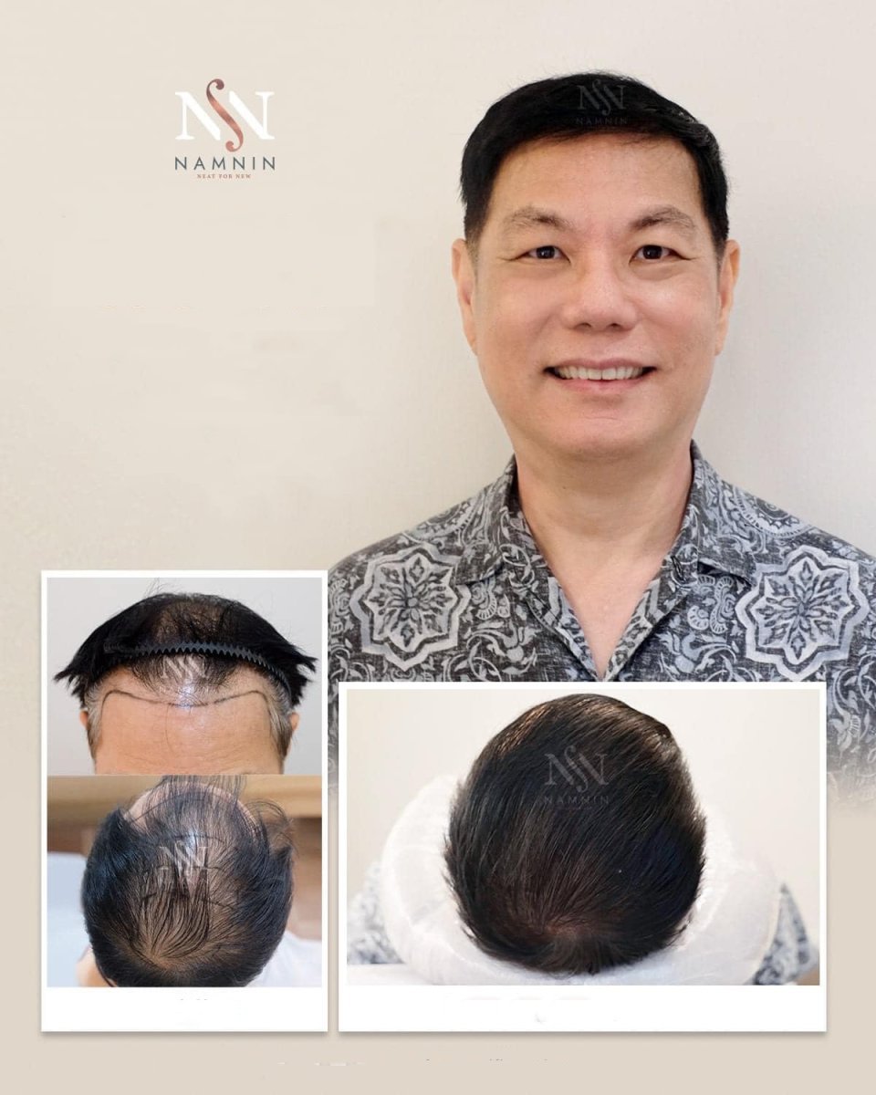 Vorher-nachher-Ergebnisse der Haartransplantation in der Namninforv Clinic, volle Haarlinie